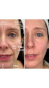 Dermal Fillers look fake and are a thing of the past 🙅‍♀️ NOT TRUE‼️, One  of my favorite transformations of 2025, starting her journey with me in  October 2024 to the present 🙌, The journey will be ...