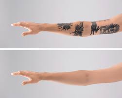 Because it's considered an elective cosmetic treatment, insurance won't cover the removal of an unwanted tattoo. Laser Tattoo Removal Usf Health