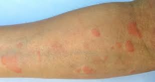 For more information, see the cks topic on hiv hiv infection and aids. Lupus What Disease Is It And What Causes It Ecosh Life