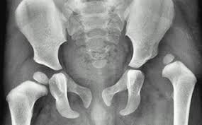 Image result for Hip Dislocation