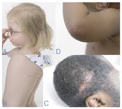 Eat foods rich in antioxidants such ad spinach, carrots, green leafy vegetables, beat roots, raspberries, etc. Skin Cancer Associated Genodermatoses A Literature Review Html Acta Dermato Venereologica