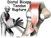Image result for icd 10 code for right shoulder partial biceps tendon tear