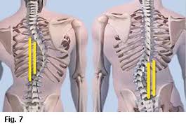 Scoliosis Fixed Or Fixable Scoliosis Scoliosis Exercises Scoliosis Surgery