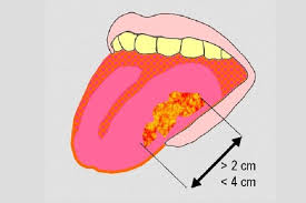 Ciri Ciri Kanker Lidah Stadium Awal Halaman All Kompas Com