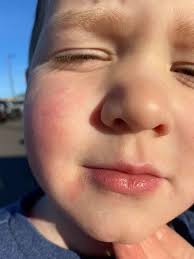 My son has a bunch of red little bumps