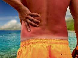 Sunburn Treatments Home Remedies And Prevention
