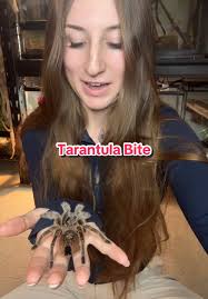 Image result for Tarantula Bite