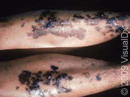 Image result for Pigment stains on the shin