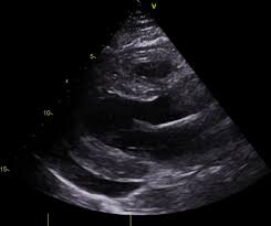 The possible pathophysiology and proposed guideline. Fulminant Myocarditis As An Early Presentation Of Sars Cov 2 Bmj Case Reports