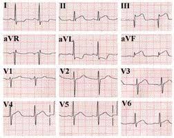 Ekg Chart Paper B Ecg P10 Www Cardiologyforless Com Ekg