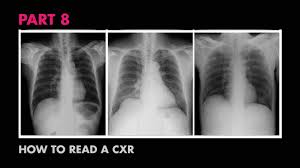 Note the blunted costophenic angles, increased cardiothroacic ratio (large heart) and upper lobe diversion. Diaphragms And Pleural Effusion How To Read A Chest X Ray Part 8 Medzcool Youtube