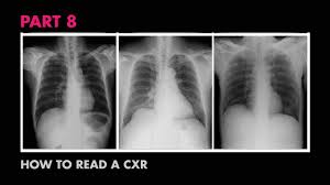Among 200 thoracenteses performed with a bilateral procedure, seven resulted in pneumothoraces. Diaphragms And Pleural Effusion How To Read A Chest X Ray Part 8 Medzcool Youtube