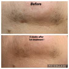 Kybella treatment (double chin removal). Ipl Laser Hair Removal Photo Facials Miss Mary Boutique Spa