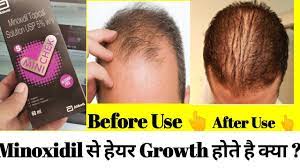 It is not used for baldness at the front of the scalp or for both men and women, hair follicles go through four different stages as each of your hairs grow, rests and eventually sheds: Mx 2 Mx 5 Solution Complete Review à¤• à¤¯ à¤¹ à¤¤ à¤¹ Minoxidil à¤²à¤— à¤¨ à¤¸ à¤• à¤¯ Hair Growth à¤¹ à¤¤ à¤¹ Youtube