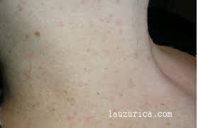 Las Verrugas Del Cuello No Son Verrugas Sino Fibromas Blandos Cuaderno En Piel