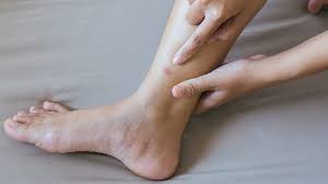 Image result for flea bites