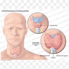 Hyperthyroidism is the state of the increased level of free thyroxin hormones which can be due to various causes including the graves disease. Goitre Graves Disease Thyroid Cancer Acromegaly Png Pngegg