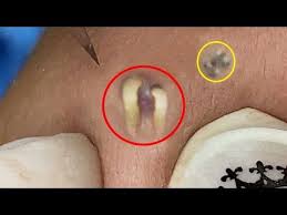 Pimple popper —aka dermatologist and tlc host dr. Satisfying Relaxing With Sac Dep Spa Video 154 Youtube In 2021 Deep Blackheads Spa Satisfying