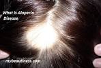 Treatment Hair Loss
