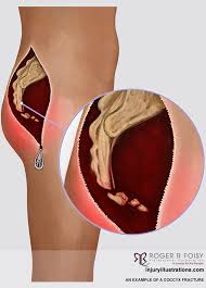 We did not find results for: Seeking Compensation For Coccyx Or Sacral Fractures