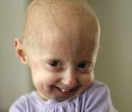 Progerin makes the nucleus unstable. About Progeria The Progeria Research Foundation