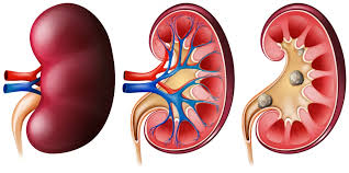 Image result for Nephrolithiasis