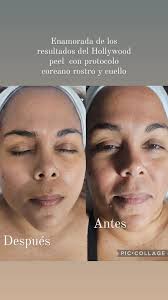 Rejuvenecimiento facial😍