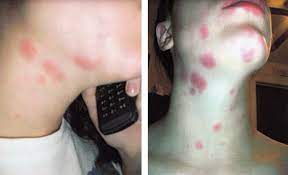 Autoimmune Progesterone Dermatitis Clinical Presentation And Management With Progesterone Desensitization For Successful In Vitro Fertilization Fertility And Sterility