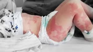 Nearly all patients in this group had cardiovascular and they more commonly had rash and mucocutaneous involvement and less commonly had shock or myocardial dysfunction. Potential Treatments For Mis C Covid 19 Illness In Kids Shared By Cdc