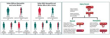 Image result for Factor IX Deficiency