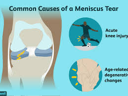 Meniscus Tears Symptoms Causes Diagnosis And Treatment