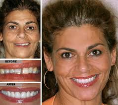 One of new york's top cosmetic dentists and haute living ambassador shares secrets to . Smile Makeover Procedure In Brooklyn Ny Cost Of Smile Makeover