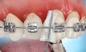 No matter your oral care regime, waterpik® offers products that fit your routine. How To Clean Brush Your Braces At Home Orthodontic