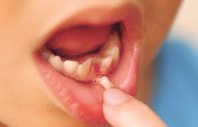 Dental Concerns Loose Teeth Loose Tooth Baby Teeth Tooth Fairy