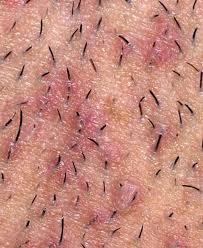 Many people have a skin type that easily produces ingrown hairs folliculitisclinic.com. Pin On Body