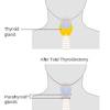 Most of the symptoms of thyroid cancer, if it is large enough, tend to be from compression of anatomical objects located in the neck (4). 1