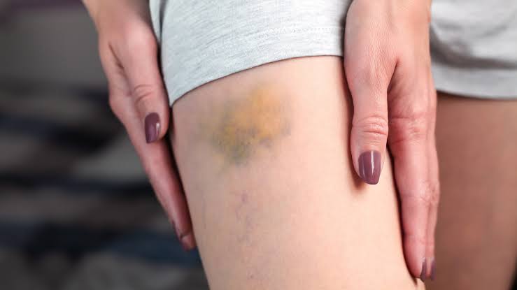 The Vitamin You Need If You Bruise Easily