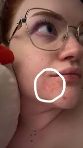 Have anybody have problems with their skin peeling or flaking