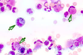 Lupus erythematodes ist eine autoimmunerkrankung der haut und gelenke. Lupus Erythematodes Diagnose Symptome Und Therapie Emedi