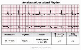 A junctional rhythm is a protective heart rhythm that occurs when the atrioventricular node this is defined as either an accelerated junctional rhythm or junctional tachycardia, depending on the rate. 13 Junctional Rhythms Ideas Ekg Interpretation Cardiac Nursing Nursing Mnemonics