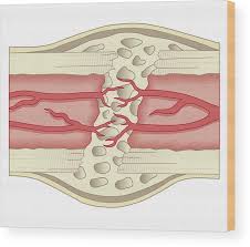 Hi all, i have uploaded a new medical animation tutorial. Cross Section Of A Bone Cross Section Of A Femur Bone Showing The Anatomical Structure Stock Photo Alamy The Section Has Been Ground And Dried Hence The Lacunae