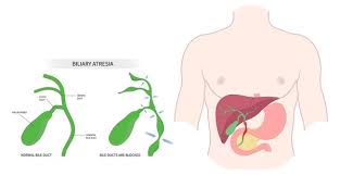Image result for acholic stools human