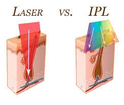 Hair is cut off at the tip, so it feel sharper when it grows back; 8 Ipl Ideas Ipl Laser Hair Removal Laser Hair