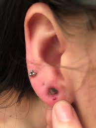 I Was Getting In The Shower So I Took Out My Plugs Silicone 00 And Noticed I Have A Blood Blister In My Ear Well I Think It S A Blood Blister I