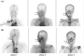 Image result for Osteomyelitis Bone Scan