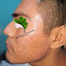 DR.ALCOCERDERMA (@dr.ignacioalcocerdermatologo) · Instagram photos and  videos