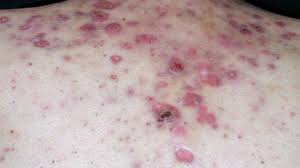 Nodular acne is a severe type of acne that causes hard, painful lesions on the skin. Nodular Acne Symptoms Treatment Scarring And More