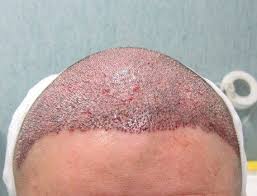 A hurricane and marketing woes couldn't keep these persistent franchisees down. Foto Trapianto Capelli Prima E Dopo Masullo Medical Group