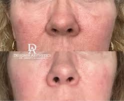 Radiofrequency Microneedling
