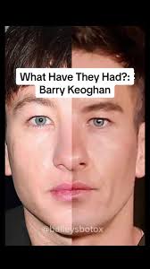 Opiniones sobre la cirugía plástica de Barry Keoghan